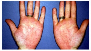 5 symptoms of Liver disease that can only be seen on hands and feet