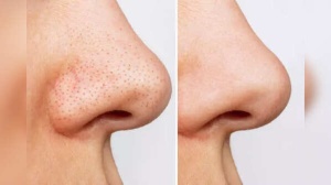 How to remove blackheads with a simple towel