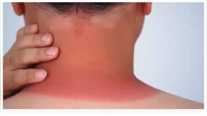 5 very early signs of Skin Cancer that are easily ignored