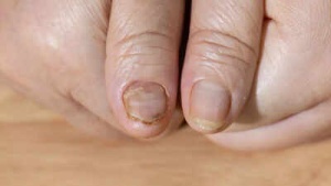 Brittle nails could be a sign of serious health problems: Causes and underlying conditions explained