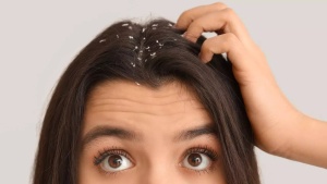 What is sticky, oily dandruff: Know its causes, why regular shampoo fails, and how to manage
